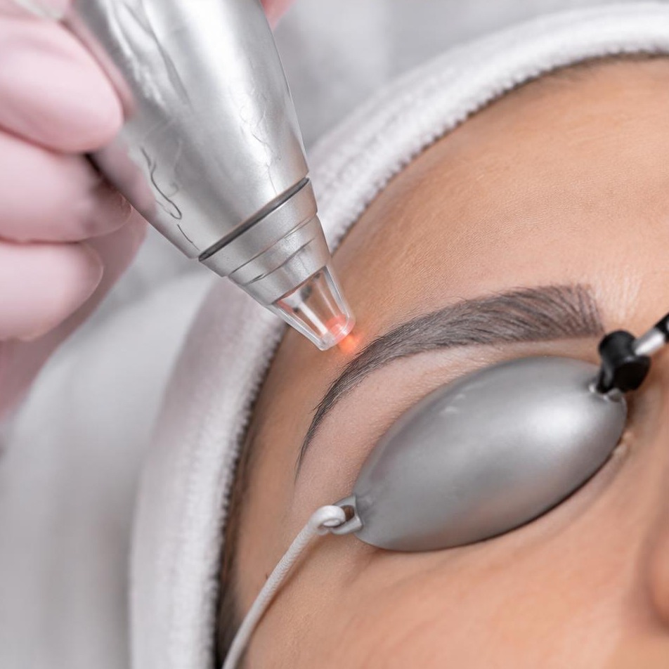 Détatouage sourcils